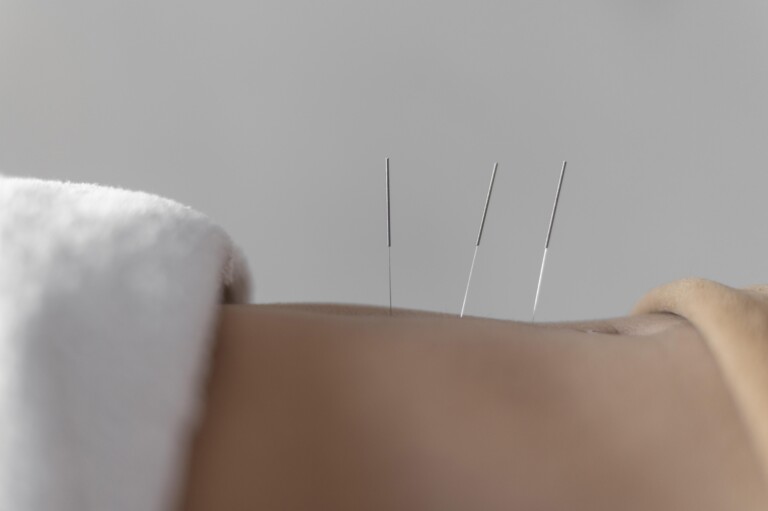 para que sirve la acupuntura